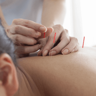 Acupuncture Service in Calgary